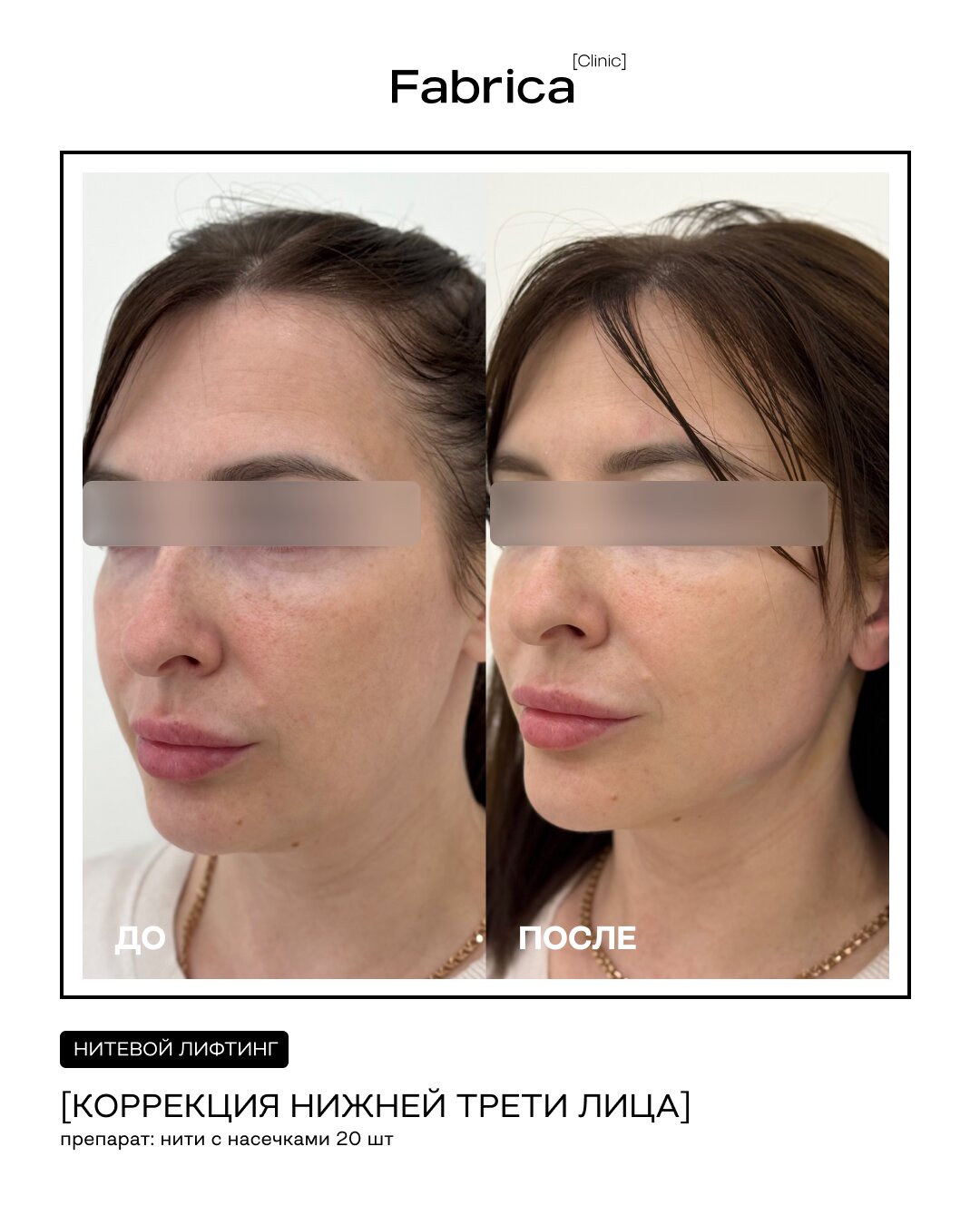 Нитевой лифтинг — коррекция нижней трети лица, Fabrica clinic