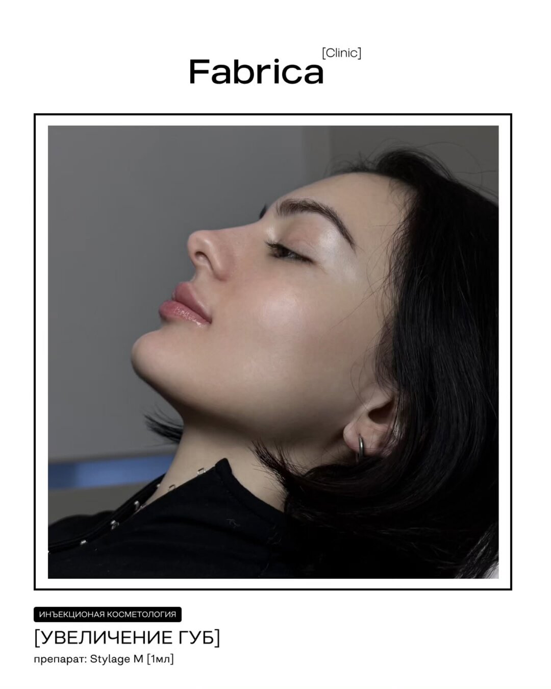 Увеличение губ, препарат Stylage M — Fabrica clinic